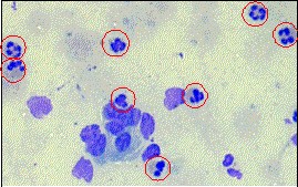 炎症性を示す多形核白血球